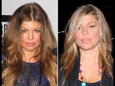 Fergie Plastic Surgery – Increasing Her Sexiness
